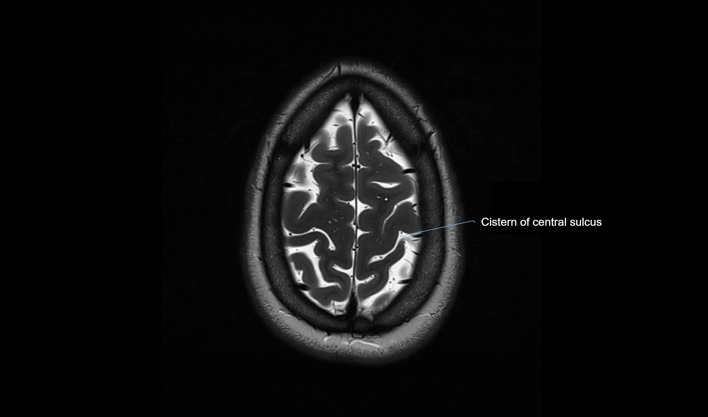 Brain cisterns  and ventricles  axial anatomy 3T MRI image-img-00001-00052.webp